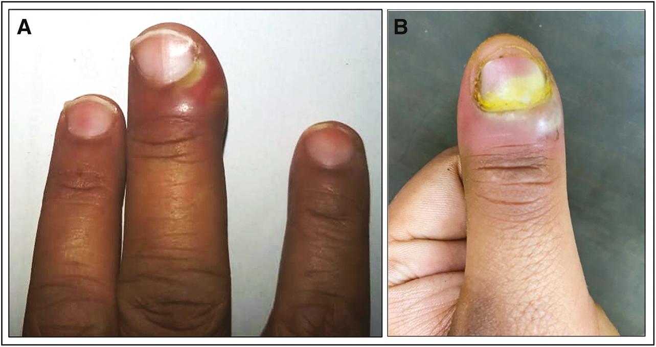 (A) Acute paronychia presenting as erythema, swelling and pus discharge along the lateral and proximal nail fold. (B) Acute paronychia of the thumb with abscess formation