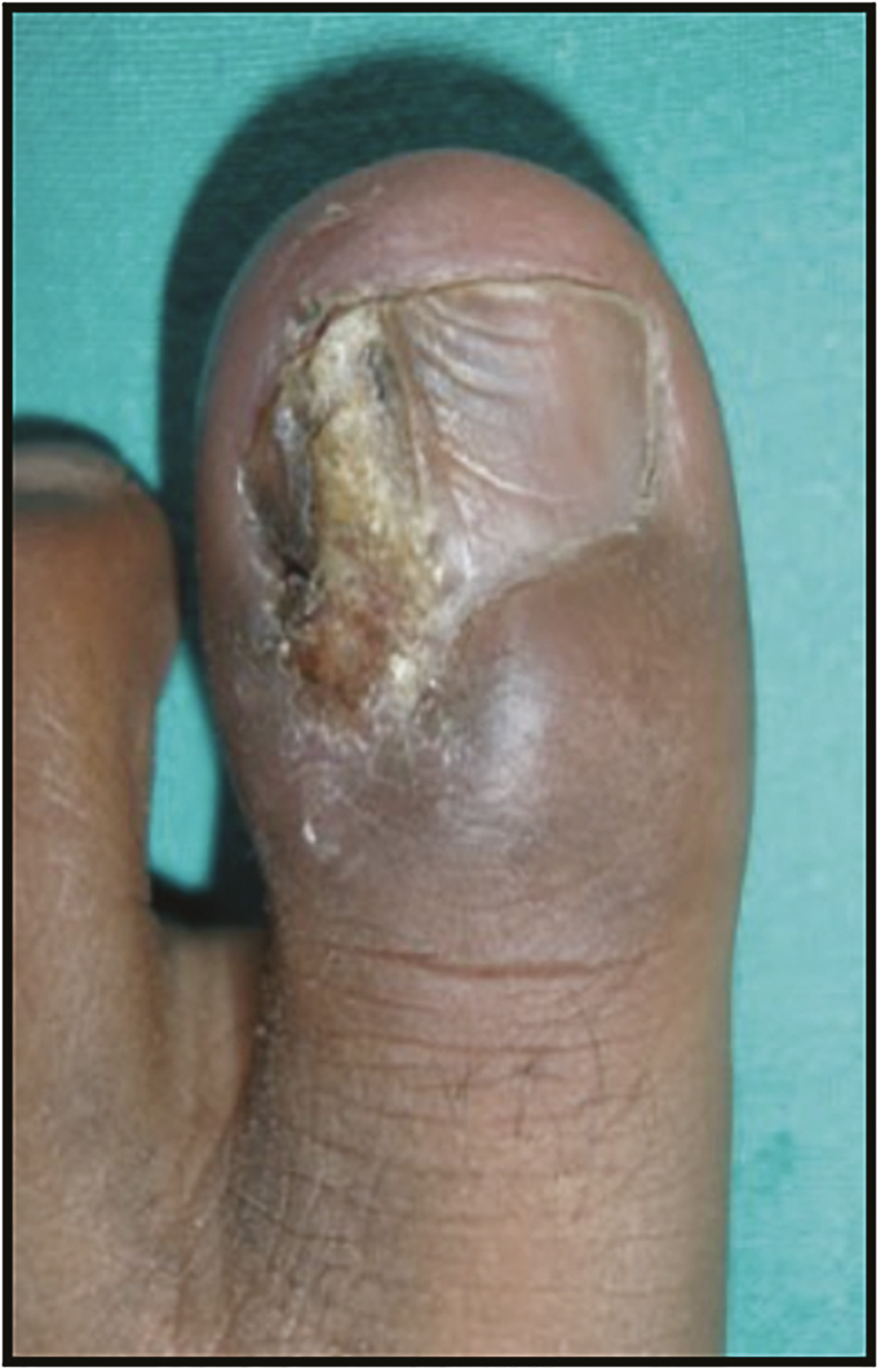 Chronic paronychia associated with tuberculosis