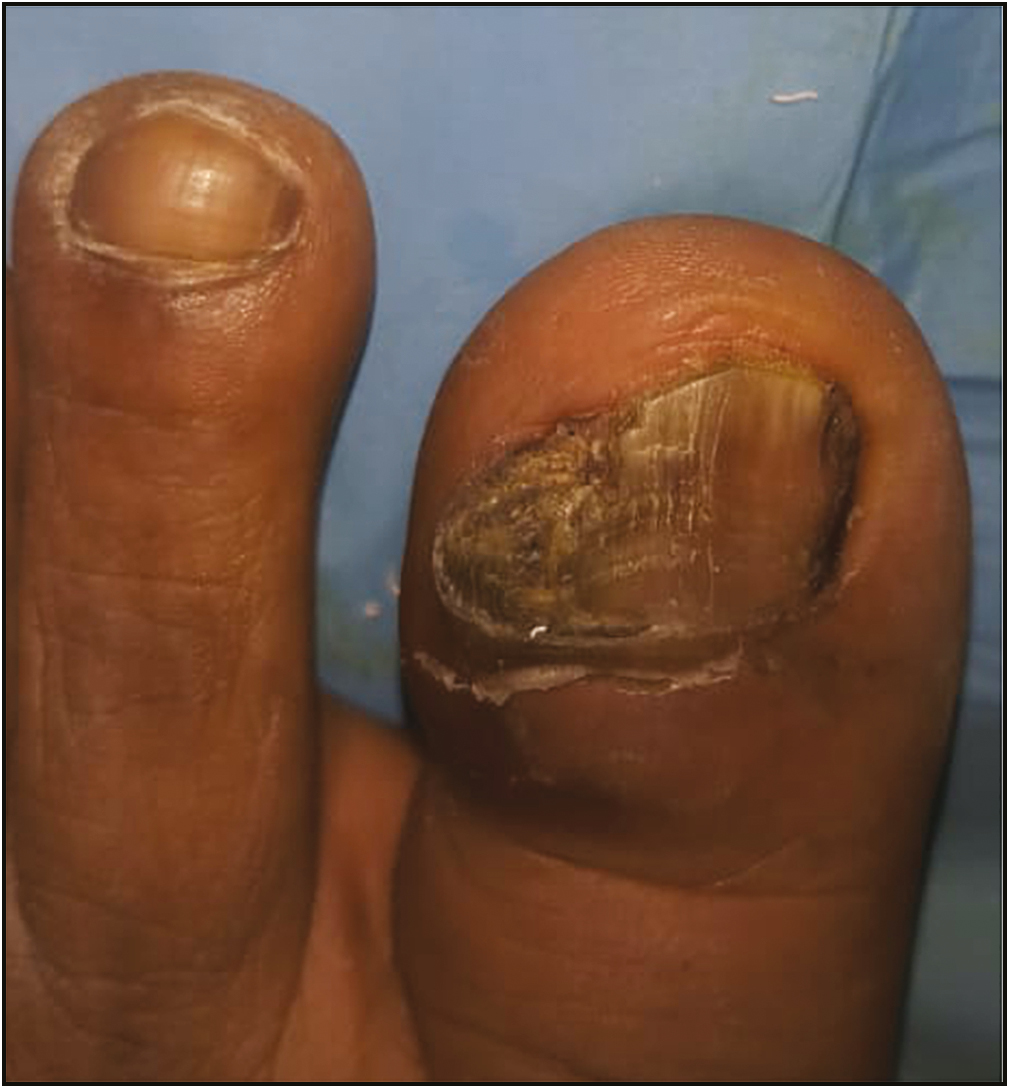 Chronic paronychia associated with an underlying malignancy (squamous cell carcinoma)