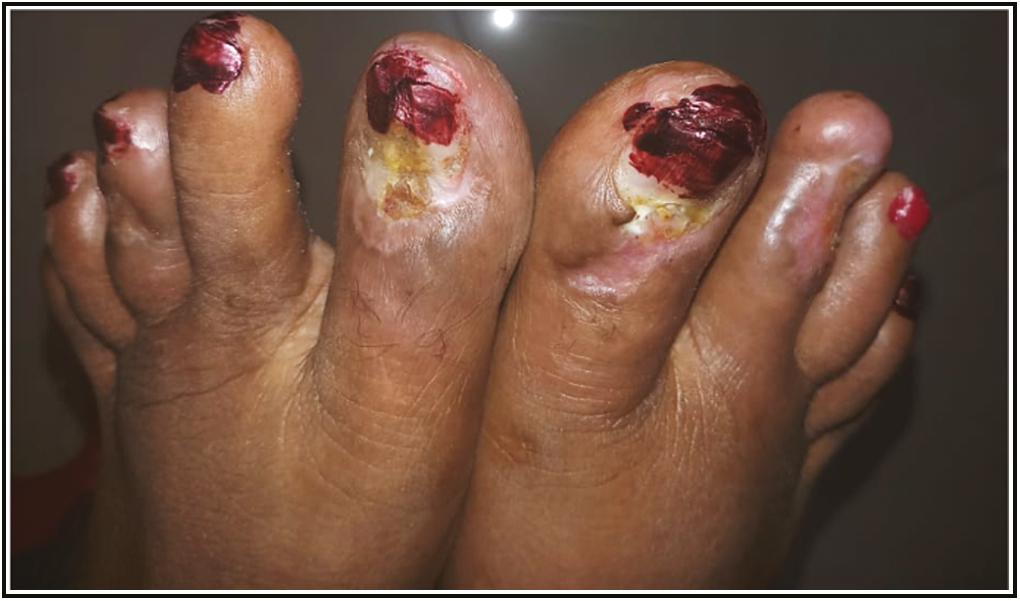 Chronic paronychia associated with underlying peripheral vascular disease