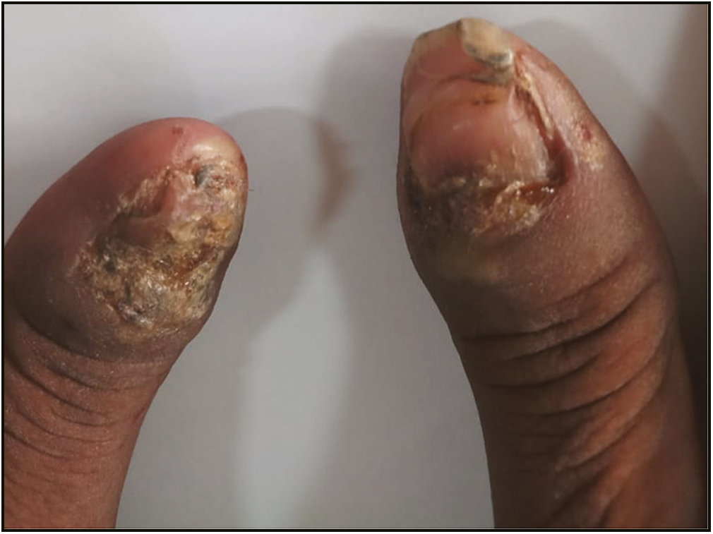 Chronic paronychia with nail dystrophy in a patient with pemphigus vulgaris