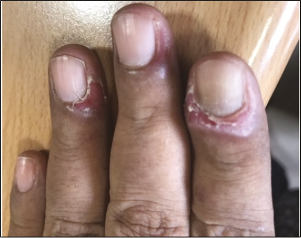 Chronic paronychia in a case of psoriasis vulgaris