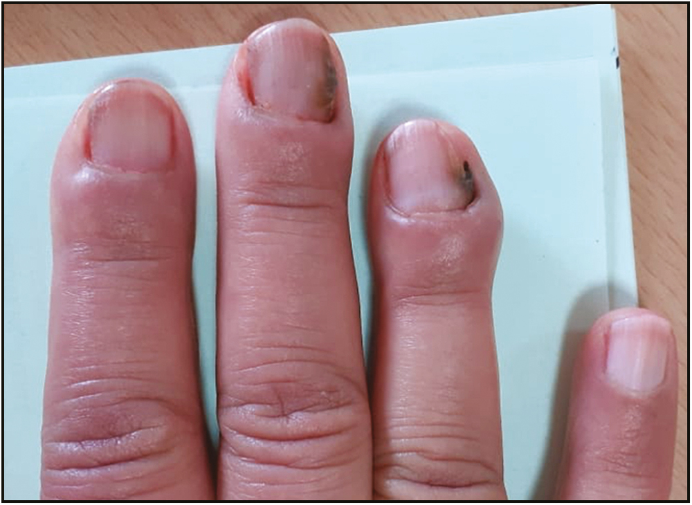 Chronic paronychia showing erythema, pain and swelling involving the perionychium of multiple digits. Loss of cuticle is also visible