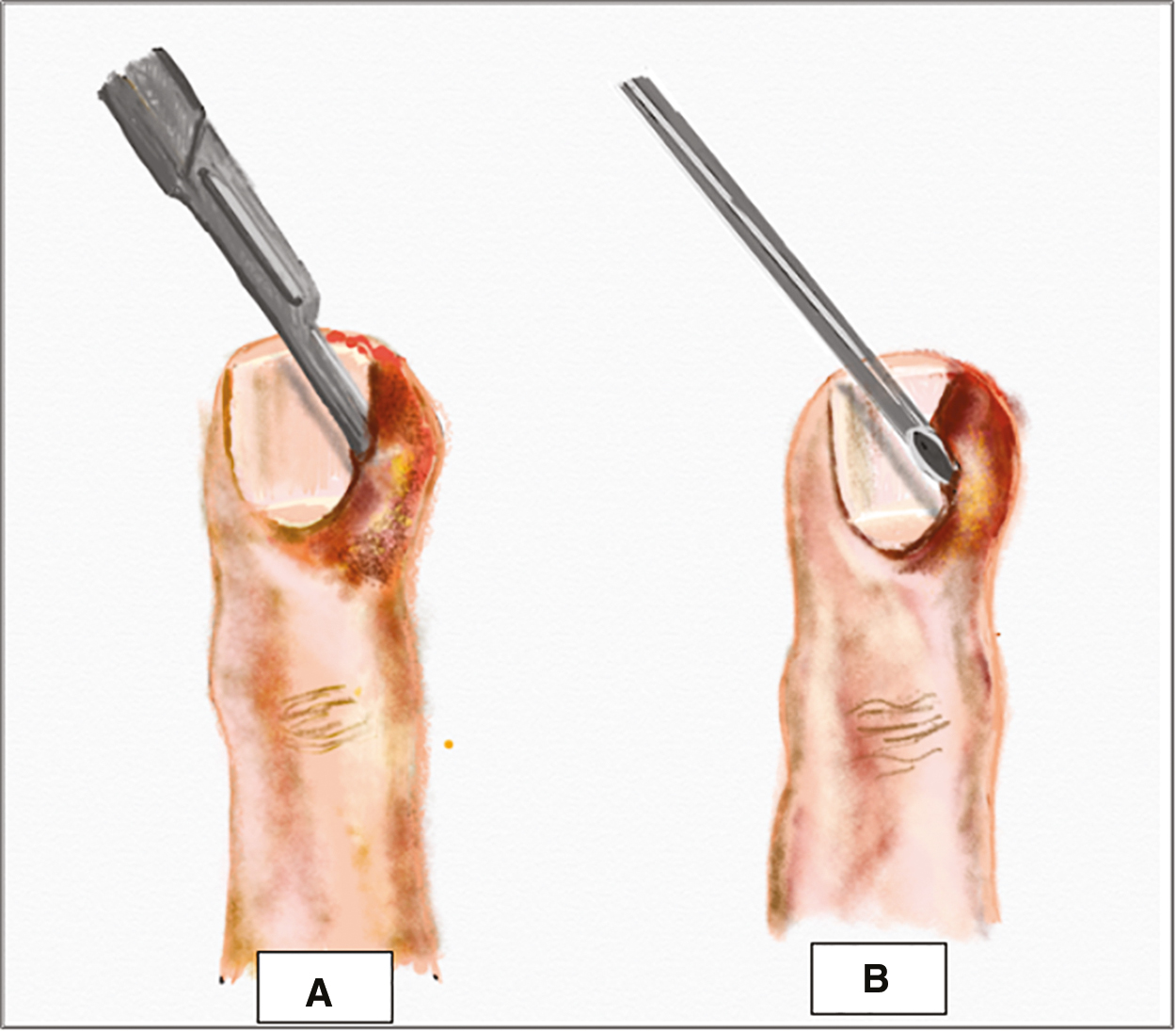 (A) No-incision technique: scalpel blade with cutting edge away from nail plate is inserted at the junction of the lateral nail fold and proximal nail fold to allow spontaneous pus drainage. (B) DAREJD technique: needle inserted into the lateral nail fold and lifted to allow pus drainage