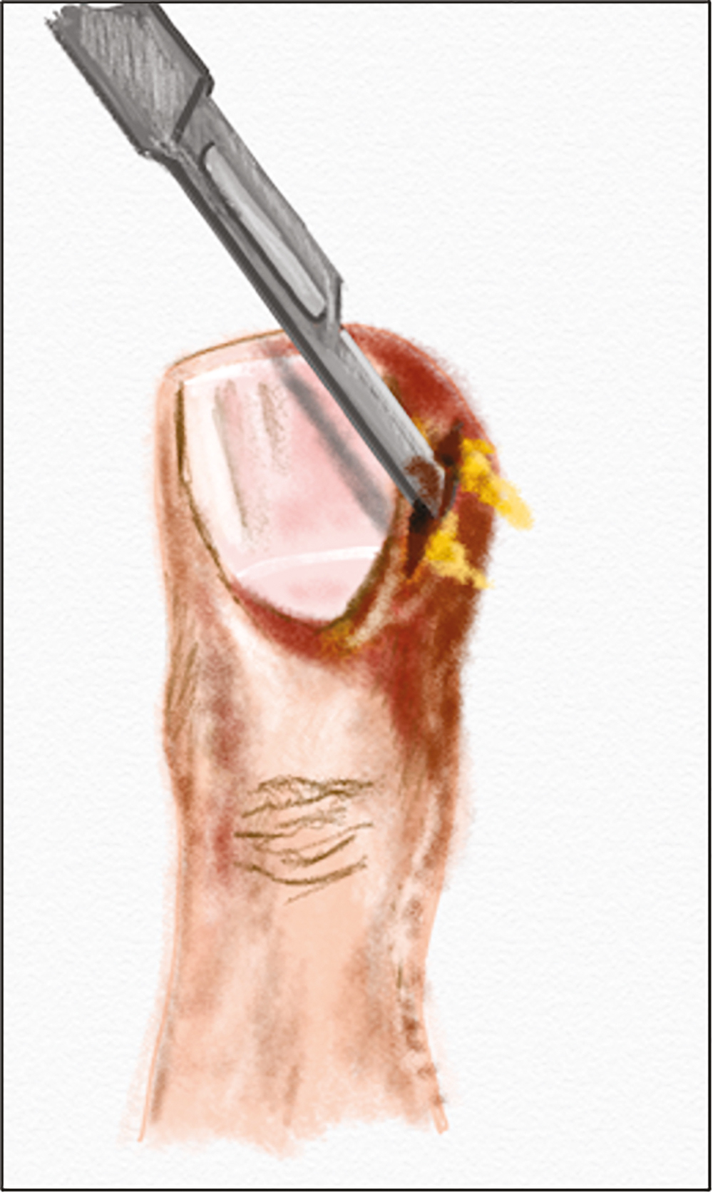 Single-incision technique: for larger abscesses, number 11 or 15 blade is used to make an incision over the abscess allowing its drainage