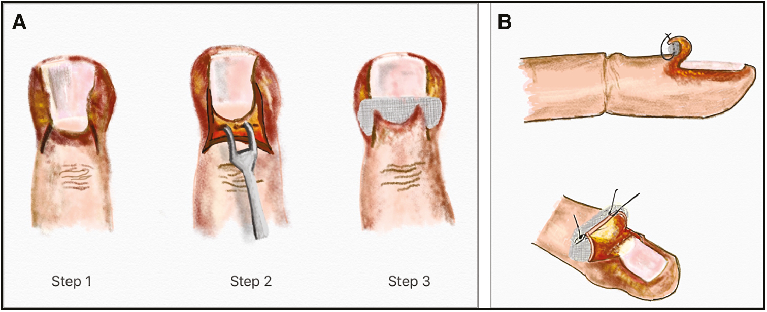 (A) Double-incision technique: when the abscess is large or entire eponychium is involved, incisions are made on both sides of the nail fold, the nail fold is reflected, cavity is irrigated and a gauze is placed inside. (B) Swiss Roll technique for a run-around abscess. After the double incision, the nail fold is reflected proximally over piece of gauze or nonadherent dressing and secured to the skin using two nonabsorbable stay sutures