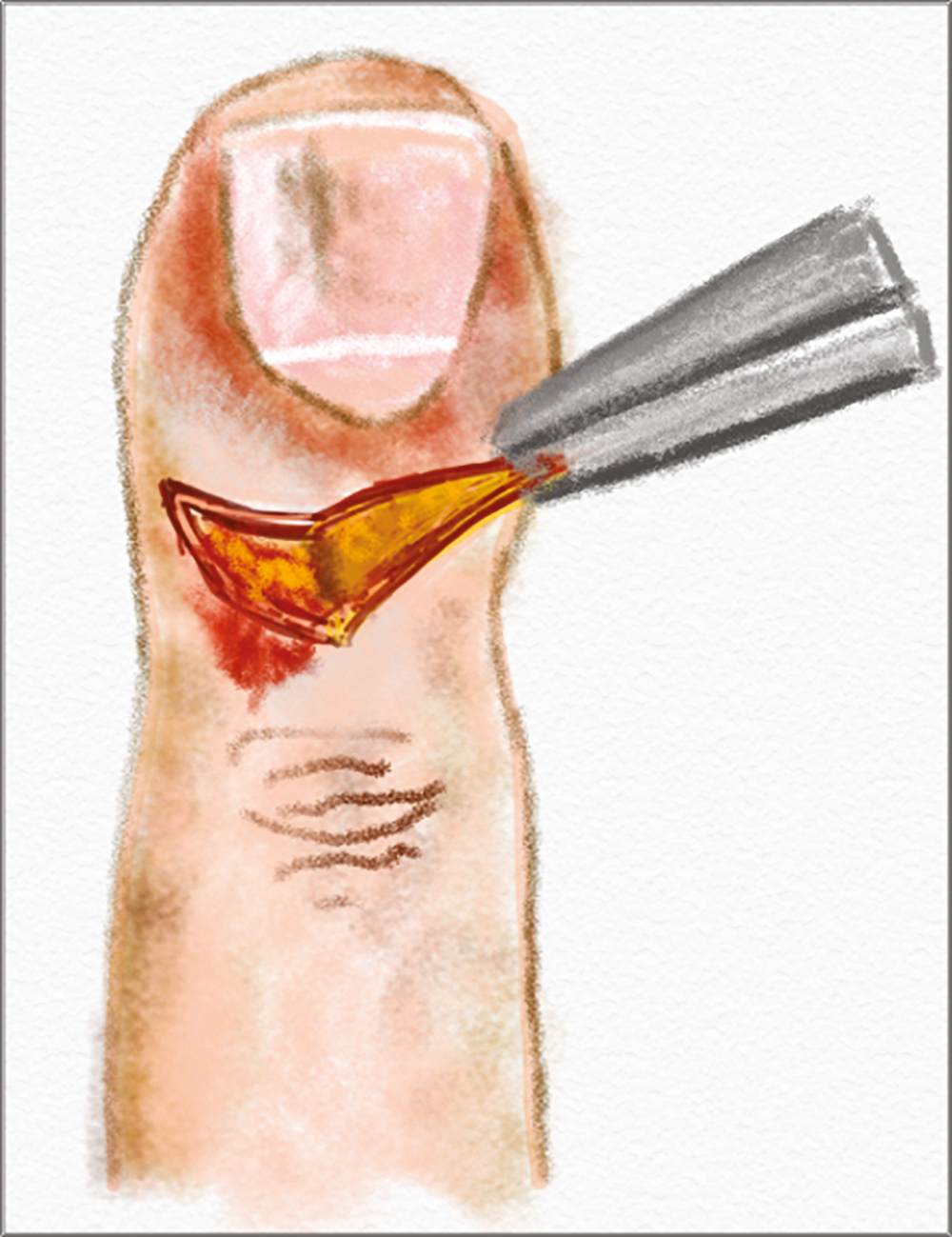 Eponychial marsupialization: excision of a crescent-shaped portion of the dorsal aspect of the proximal nail fold. The excision area starts 1 mm away from the distal margin of the eponychium extending around 6 mm proximally