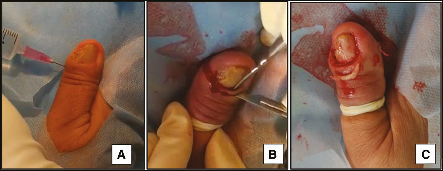 En bloc excision of the proximal nail fold: this technique involves the removal of a wedge-shaped crescent formed of the entire depth of the PNF, with a width of 5–6 mm, extending from one LNF to the other, without the removal of the nail plate