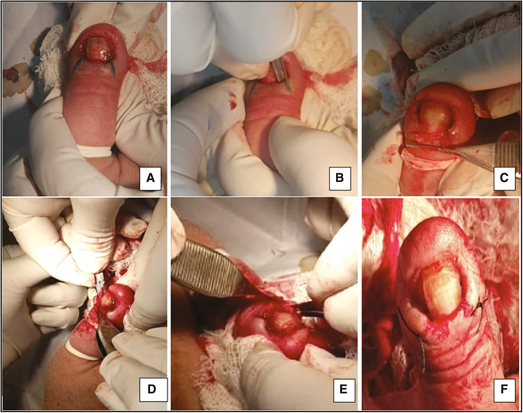 (A–F) Square flap technique. (A) Oblique marking guidelines are made on both sides of the proximal nail fold. (B) Followed by incision along these markings. Next an incision is made parallel to the epidermis and beneath the fibrosis. (C) The square flap is lifted using a forceps. (D) The fibrotic tissue lying underneath is removed while saving the epidermis of the PNF. (E) A similar incision on the LNF can be used to remove latera fibrosis. (F) The square flap is kept in place and surgical closure is done using simple interrupted sutures