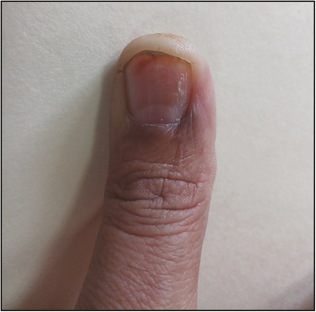 Postop (square flap technique) photograph at 2 months. Healing was observed in 2 weeks and cuticular regrowth in 6 weeks