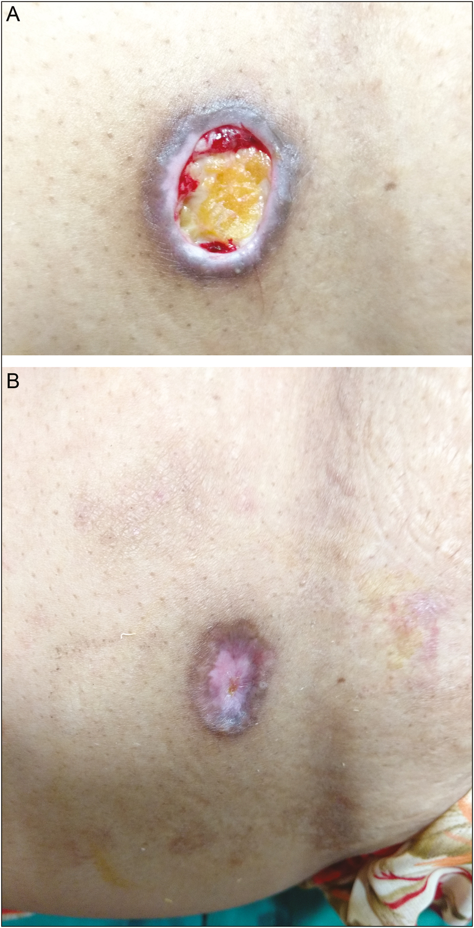 A: Ulcer before autologous PRFM application. B: Ulcer at 12 weeks after autologous PRFM application