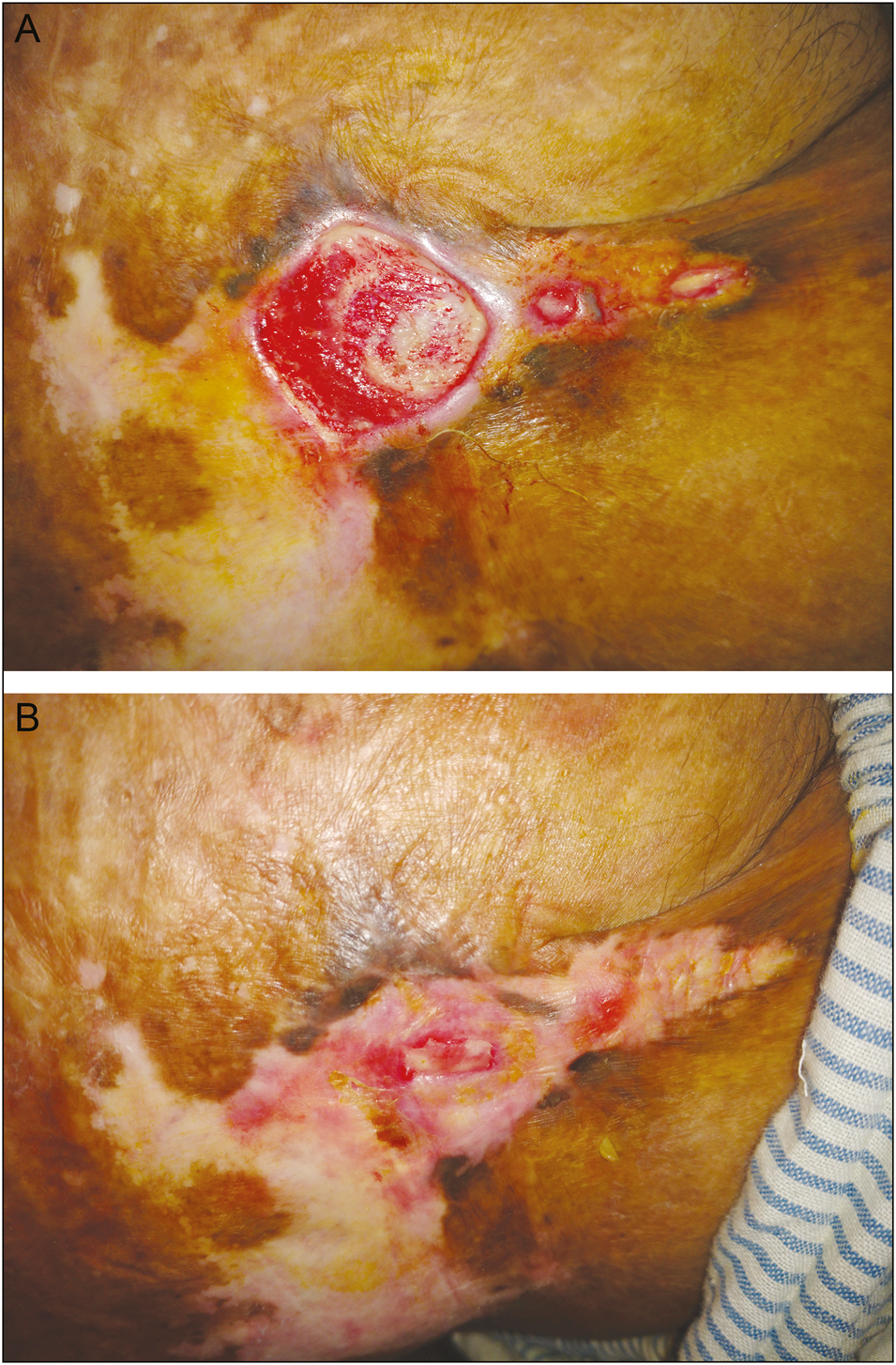 A: Ulcer prior to autologous PRFM. B: Ulcer at 12 weeks after autologous PRFM application