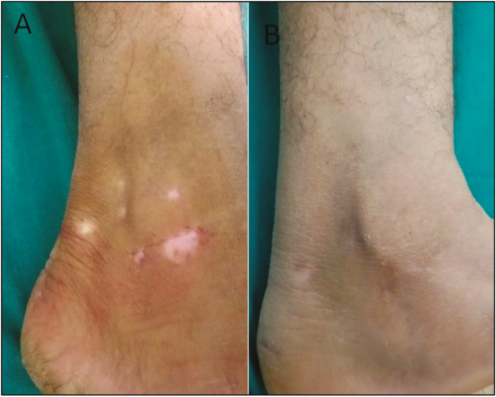 Jodhpur technique in vitiligo patch on malleoli: (A) Pretreatment and (B) posttreatment at 20 weeks