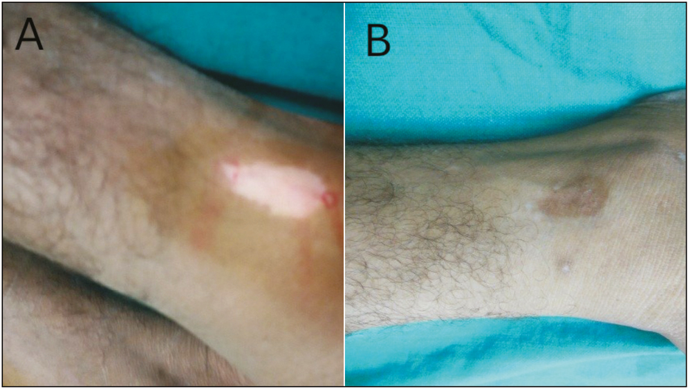 STSG in vitiligo patch on malleoli: (A) Pretreatment and (B) posttreatment at 20 weeks