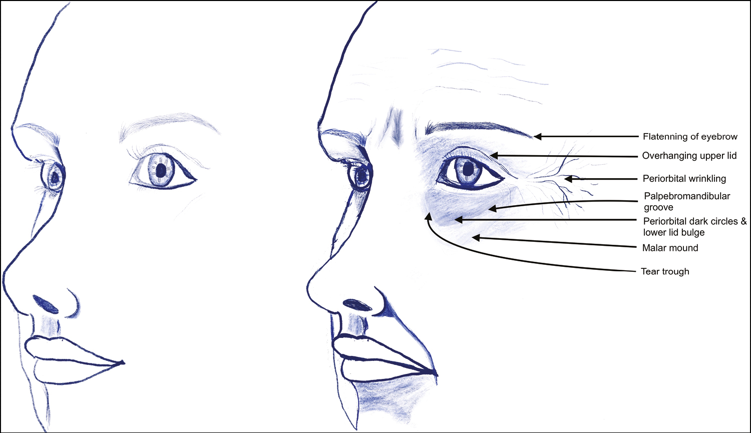 Profile of periorbital region at younger age (left) and aging changes (right) (original drawing)