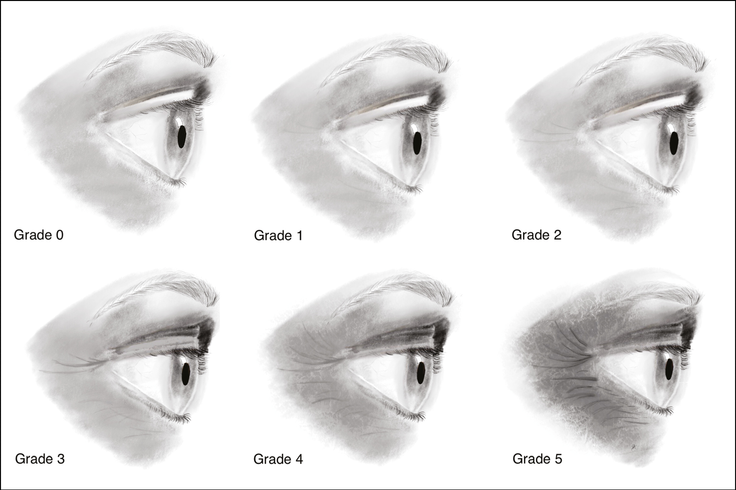 Lemperle’s wrinkle scale for periorbital region (Grade 0: no wrinkles, 1: just perceptible wrinkle, 2: shallow wrinkle, 3: moderately deep wrinkle, 4: deep wrinkle with well-defined edges, and 5: very deep wrinkle with redundant fold) (original drawing)