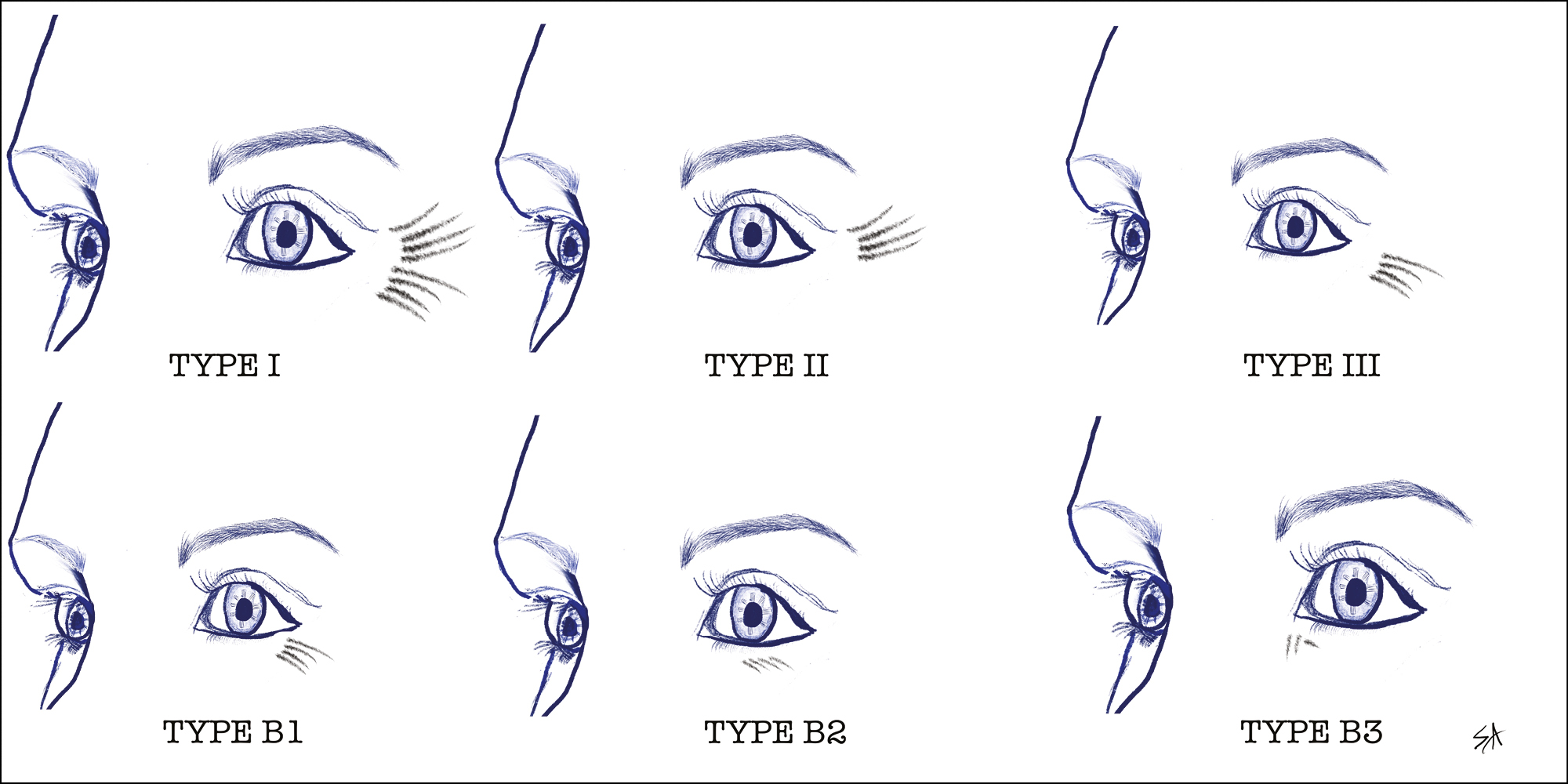 Tamura and Odo classification of periorbital wrinkles (Type I: lateral periorbital wrinkle extending from the brow to the zygomatic arch; Type II: wrinkles lateral to the external canthus of the eye, extending from the line of the external canthus of the eye to the zygomatic arch with no wrinkles in the superior lateral region; Type III: wrinkles in the line of the external canthus only; presence of lower eyelid wrinkles B1: lateral; B2: medial and B3: internal canthal wrinkles) (original drawing)