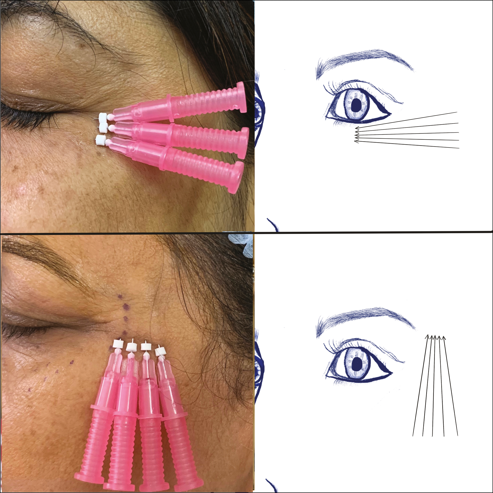 Representational image of thread insertion in the periorbital region with vectors for infraorbital (above) and lateral periorbital (below) region. (original drawing)