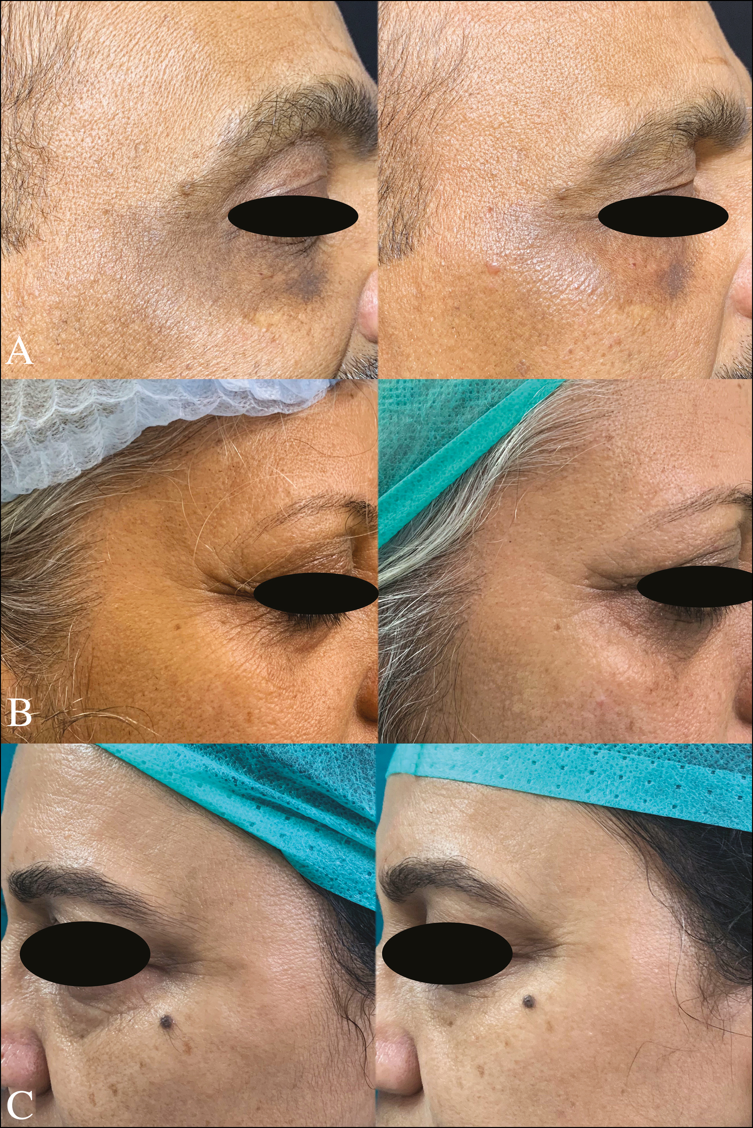 Preprocedure (left) and postprocedure (right) A: improvement in wrinkles and periocular pigmentation; B and C: improvement in wrinkles and periocular rejuvenation