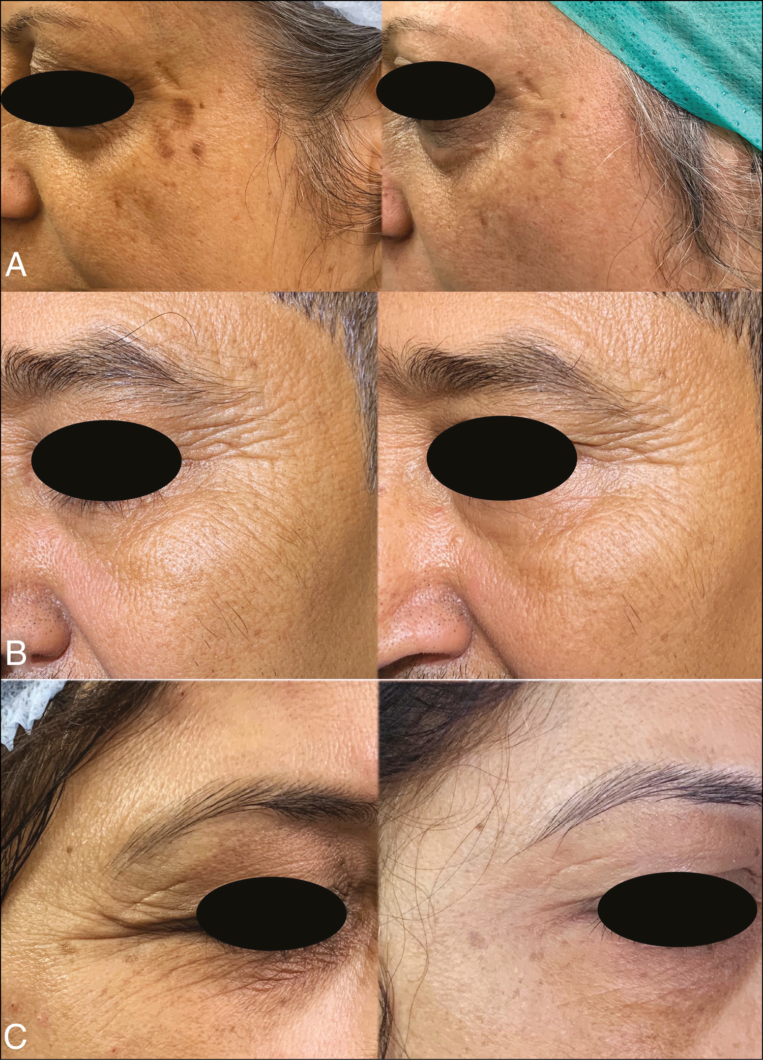 Preprocedure (left) and postprocedure (right) A: improvement in scar and wrinkles; B: poor response to treatment; C: improvement in wrinkles and rejuvenation