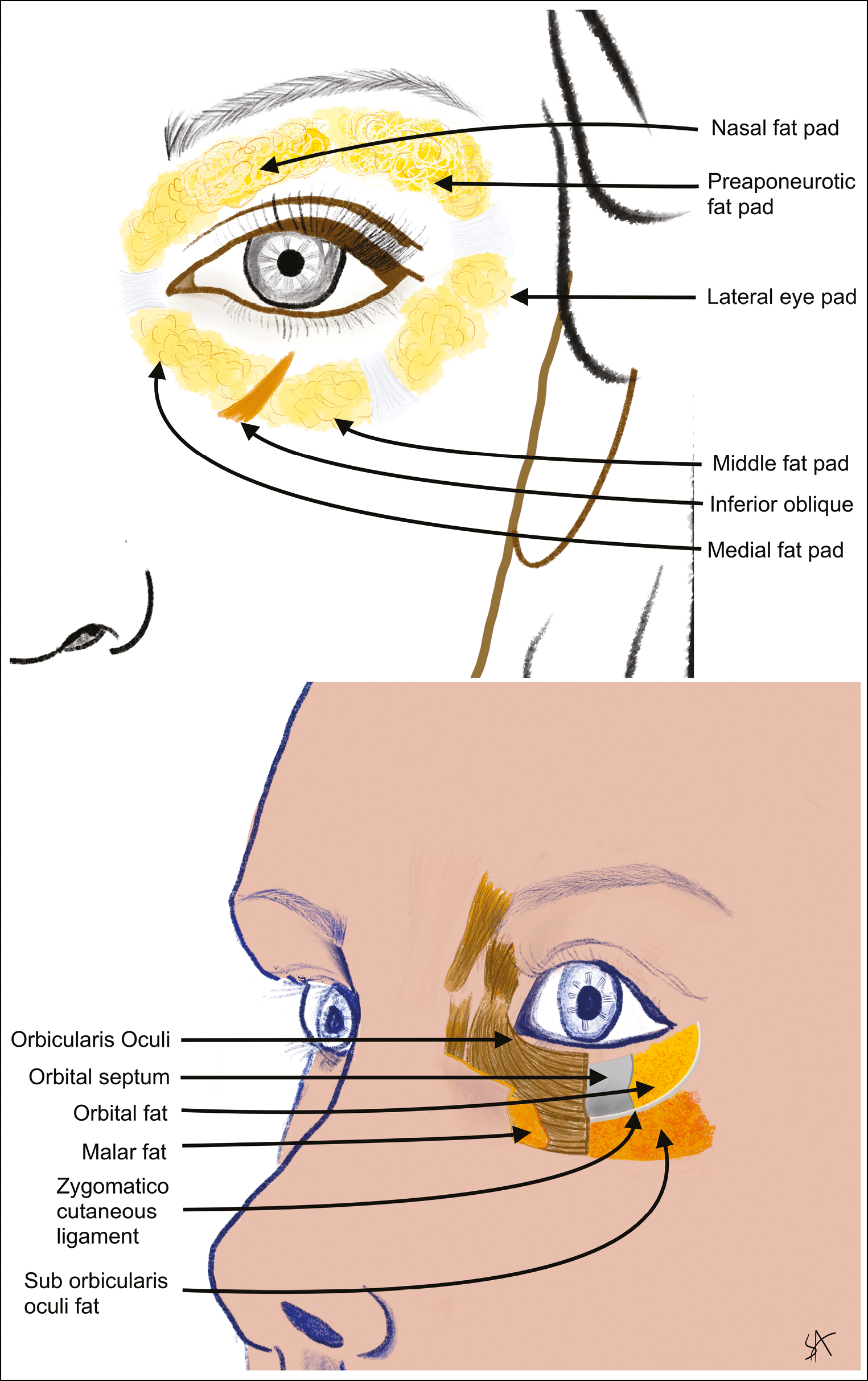 Periorbital fat pads (above) and transverse section through layers of periorbital region (below) (original drawing)