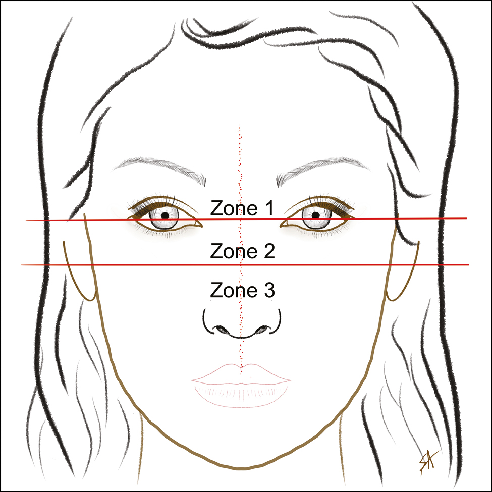 Periorbital zones (original drawing)