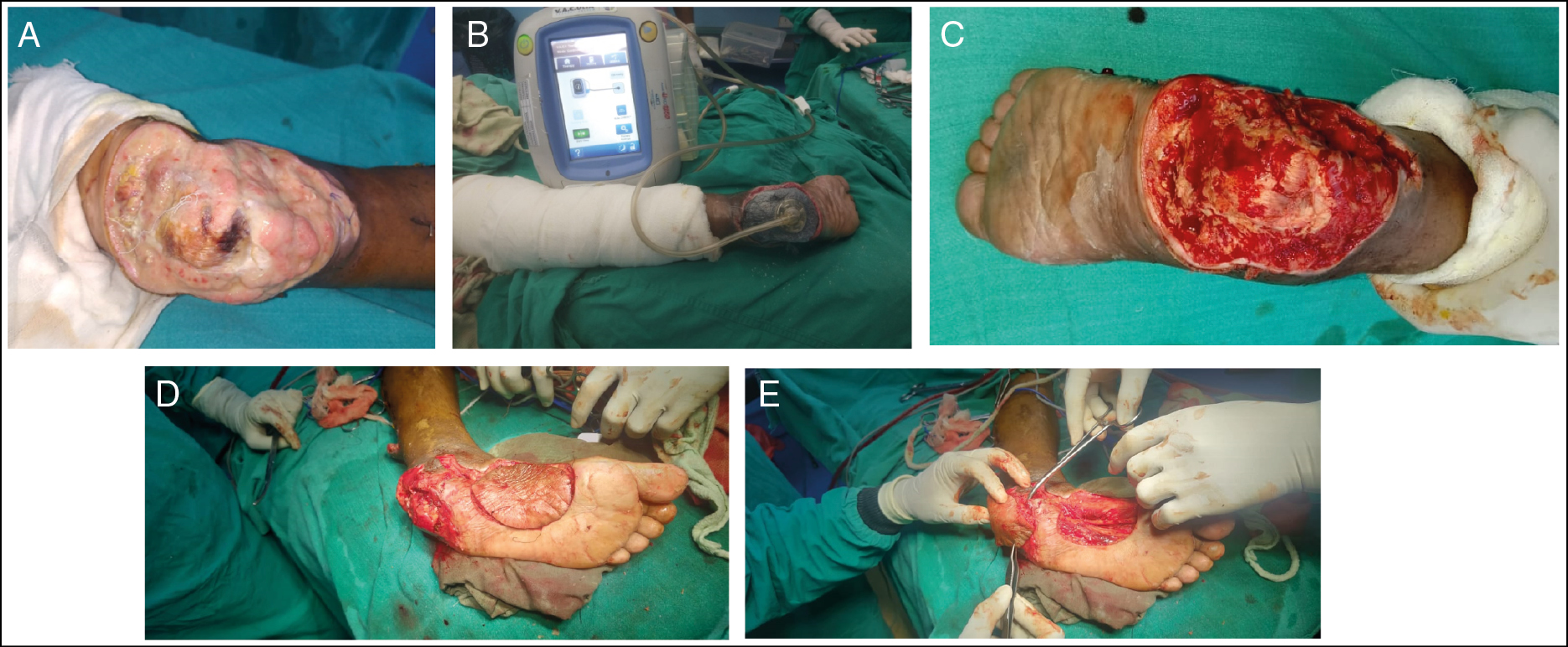 DFU at left heel. (A) Before NPWT instillation therapy. (B) NPWT instillation therapy. (C) After NPWT instillation therapy. (D) Medial plantar harvesting. (E) Medial plantar flap coverage