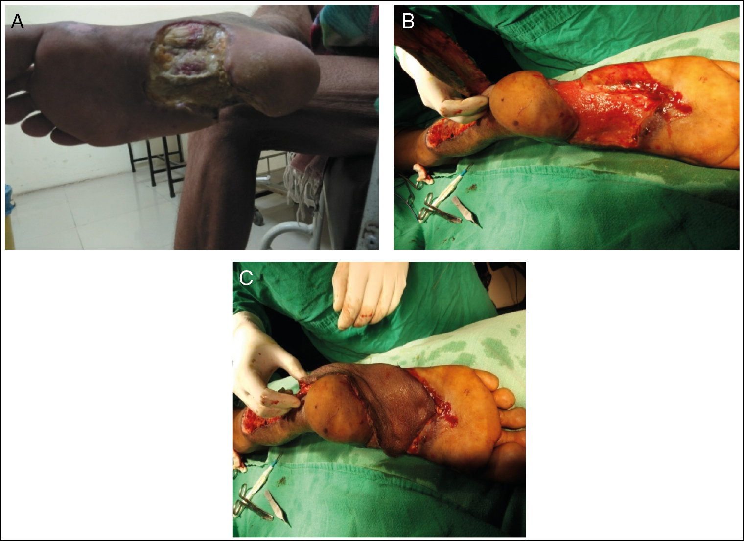 DFU medial and lateral midfoot. (A) Before NPWT application. (B) After NPWT application. (C) Reverse sural flap coverage