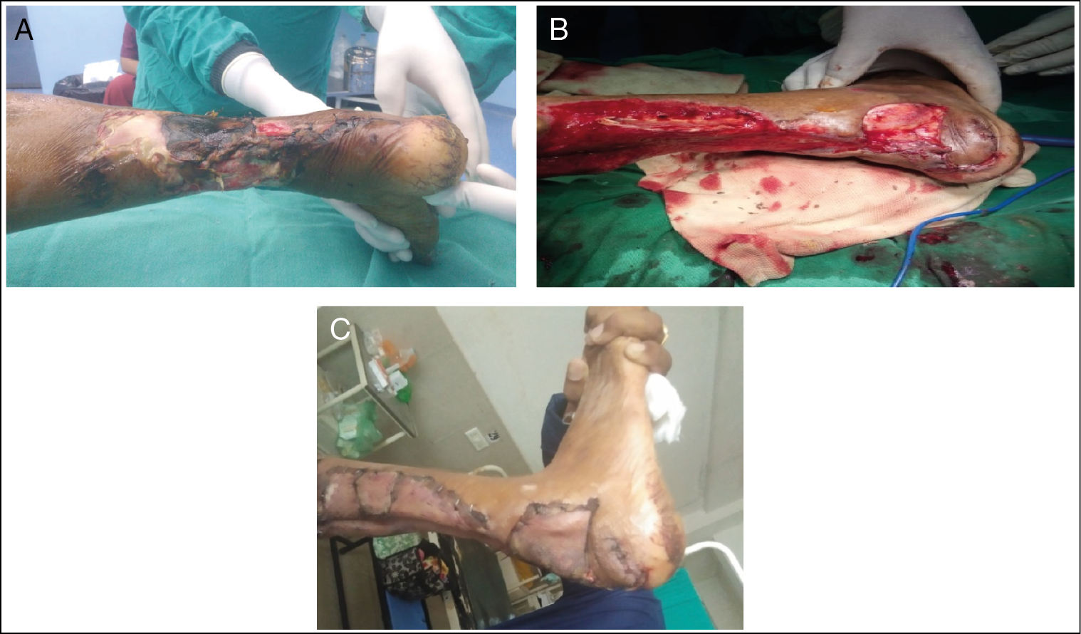 (A) DFU with necrotizing fasciitis with right tendo-achilles region. (B) After NPWT instillation. (C) Skin grafting over tendo-achilles region