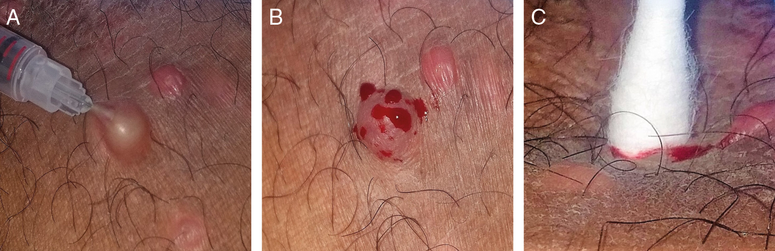 (A) An insulin syringe used to puncture MC lesion deep into the dermis, along all the axes and planes of a fully developed lesion. (B) Multiple bleeding points from the site of entry. (C) A mild compression by rotatory movements with a cotton swab