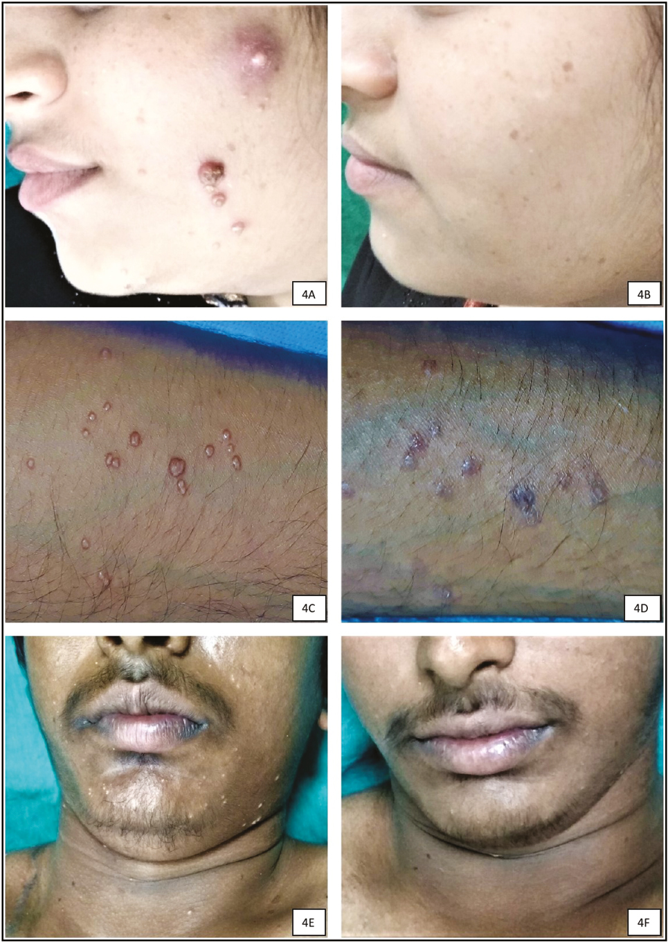 Responses to modified autoinoculation on day 0 (A, C, and E) and complete resolution at the end of 16th week (B, D, and F) follow-up