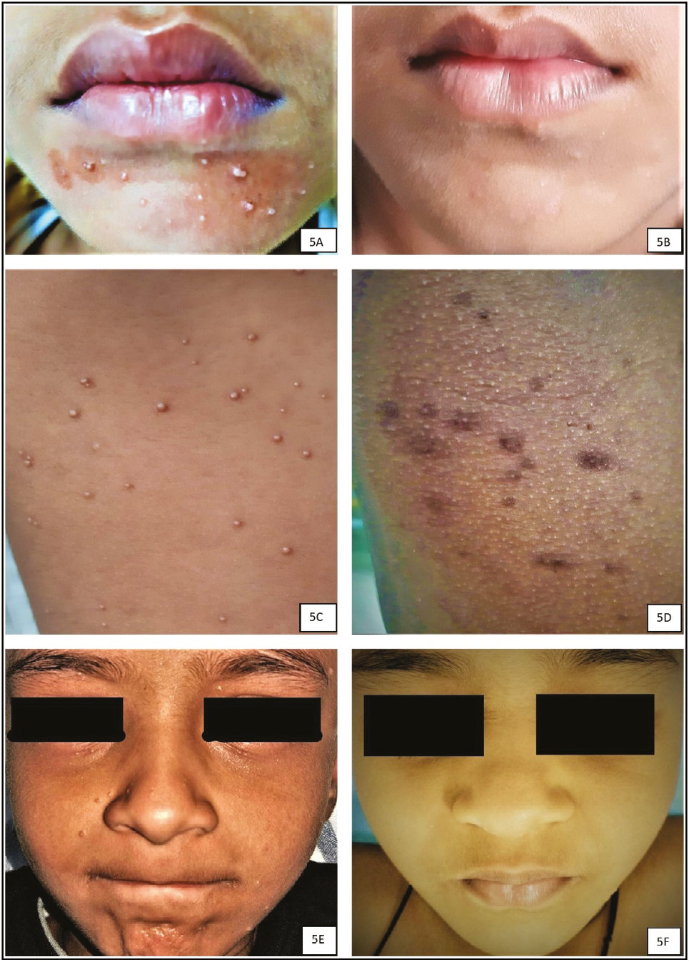 Responses to topical potassium hydroxide on day 0 (A, C, and E) and complete resolution at the end of 16th week (B, D, and F) follow-up