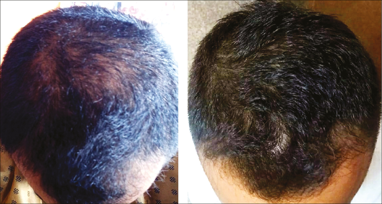 Pre- (0 month) and post-procedural (6th month) global photographic assessment showing better results with platelet-rich plasma + minoxidil 5% therapy at the end of 6th month