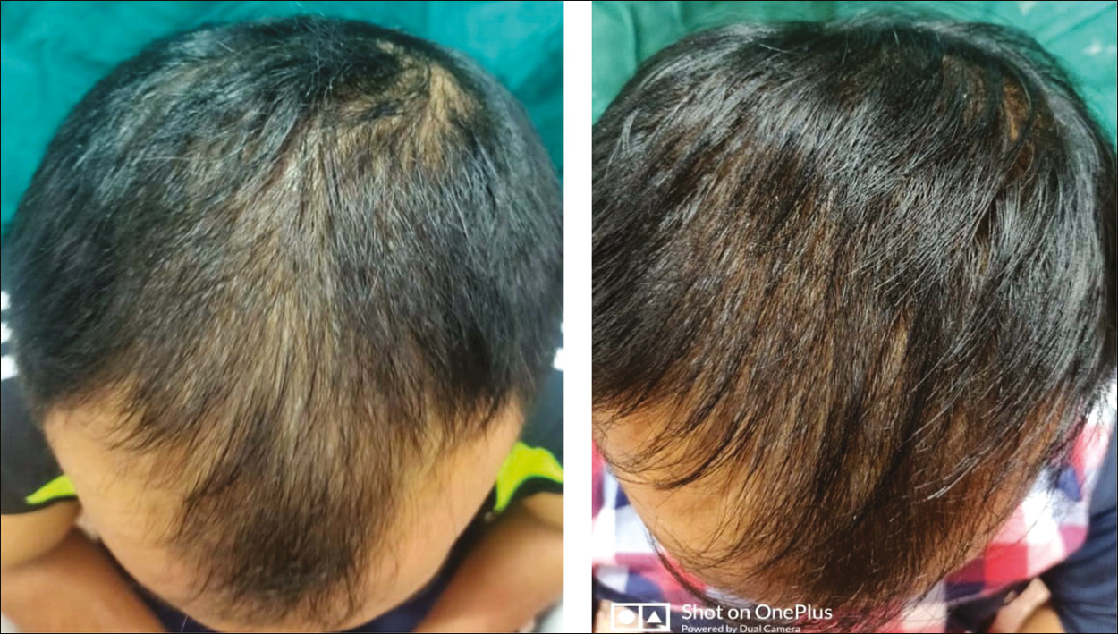 Pre- (0 month) and post-procedural (6th month) global photographic assessment showing good results with platelet-rich plasma + minoxidil 5% therapy at the end of 6th month