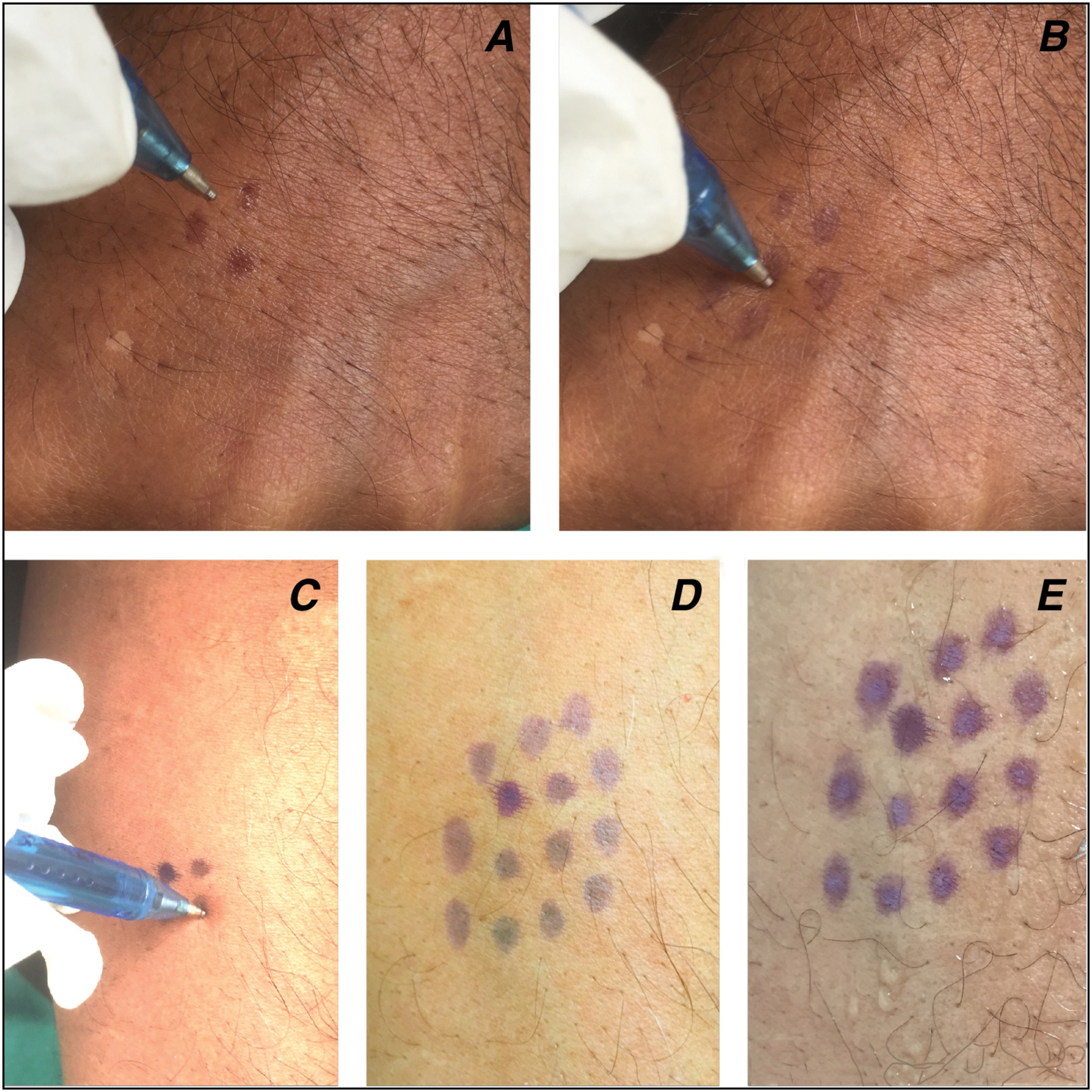 (A–E) The uniform chemical spots of phenol (A and B) and of TCA (C–E) on skin