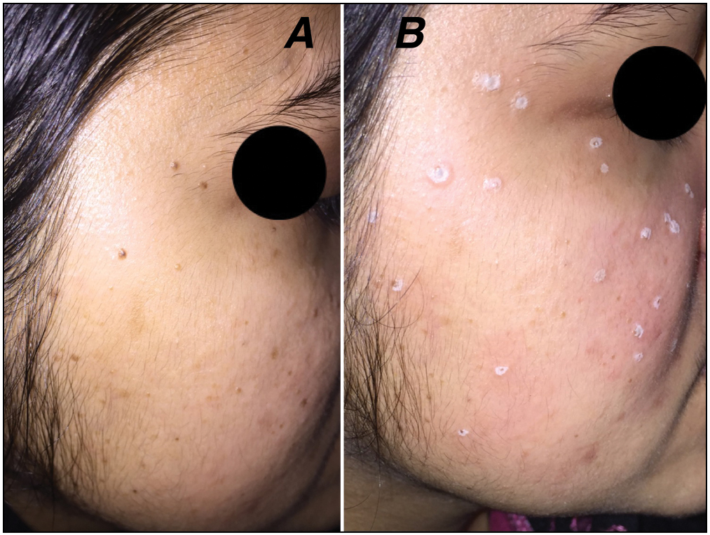 (A and B) A patient with multiple freckles precisely cauterized using the chemical ball pen