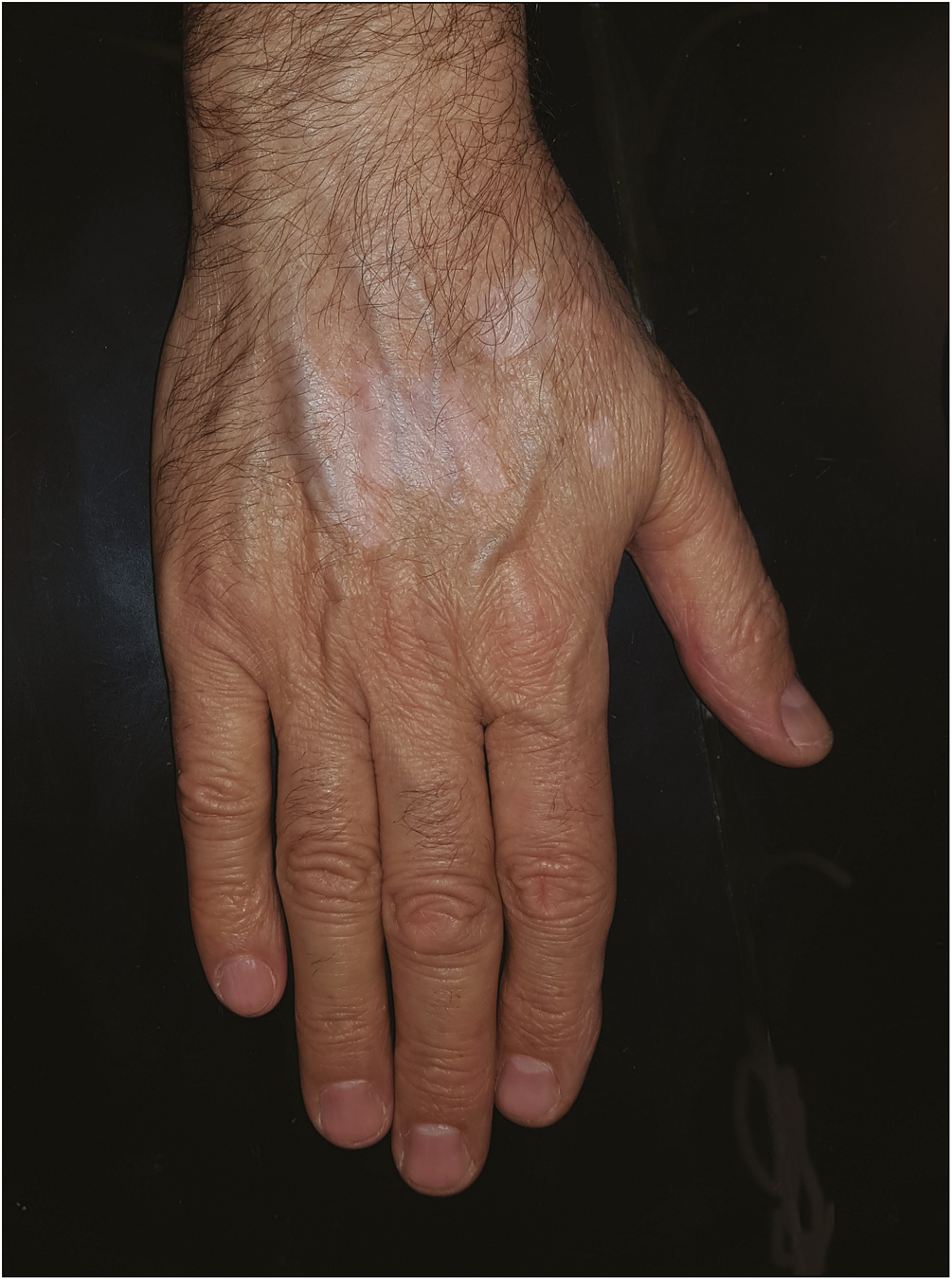 Vitiligo over the dorsum of the hands