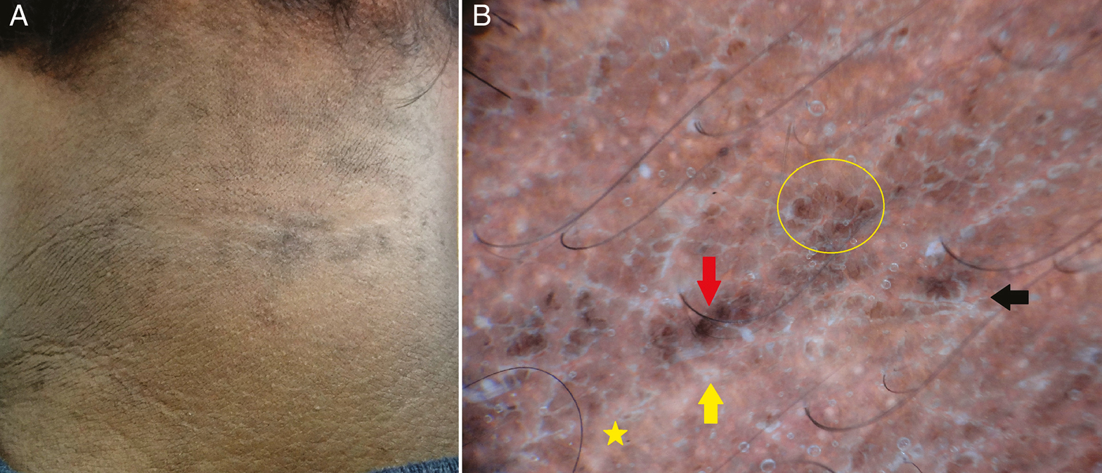 (A) Clinical image of confluent reticulated papillomatosis with dirty-looking hyperpigmented papules on the neck. (B) Dermoscopy shows ridges (red arrow) and fissures (yellow arrow) and brown globules in a “cobblestone” pattern (yellow circle). Scales in the fissures (black arrow) and white areas (yellow star) are well appreciated (Illuco 1100 IDS, Polarized, 10x)