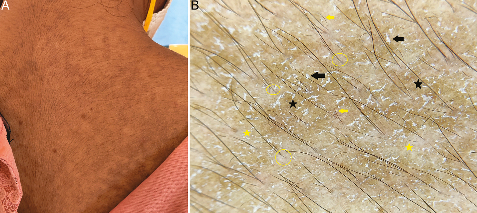 (A) Clinical image of confluent reticulated papillomatosis with dirty-looking hyperpigmented and hyperkeratotic papules on the back. (B) Dermoscopy shows brown globules (black stars) with surface scales (black arrows) and focal white areas (yellow stars). Note the broken hairs (yellow arrows) and V-like hairs (yellow circles) (Illuco 1100 IDS, Polarized, 10x)