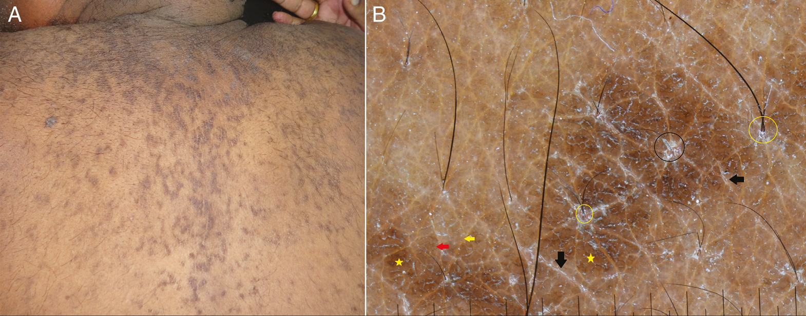 (A) Clinical image of confluent reticulated papillomatosis showing dirty-looking hyperkeratotic papules in a reticulated pattern on the back. (B) Dermoscopy shows ridges (red arrow) and fissures (yellow arrow) and brown globules in a “cobblestone” pattern (yellow stars). Scales in the fissures (black arrows) and around follicles (black circles) are seen. Note the V-hair (yellow circles) (Illuco 1100 IDS, Polarized, 10x)