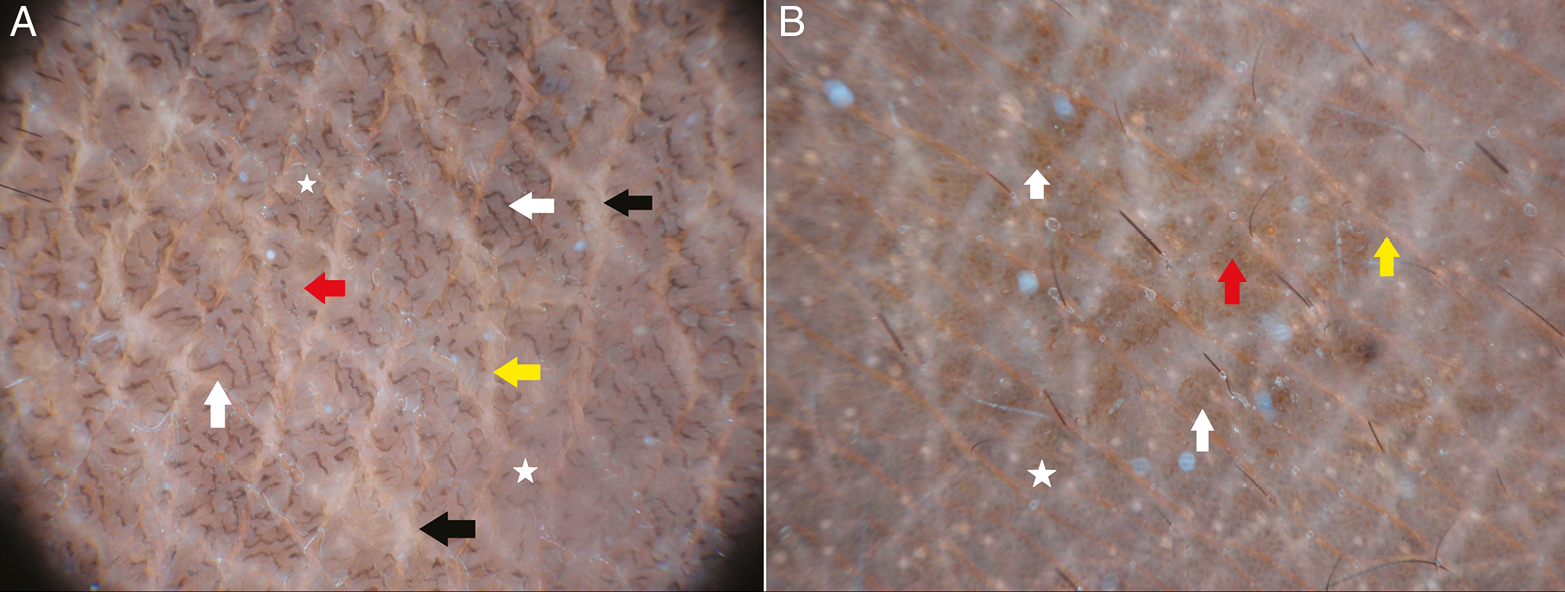 Dermoscopic image of confluent reticulated papillomatosis (A) and (B) shows ridges (red arrow) and fissures (yellow arrow) in a cerebriform pattern. Note the grayish-brown globules (white stars) and linear brown globular structures (white arrows) with focal white areas (black arrows) (A). Brown (white arrows) and grayish-black globules (white star) are seen (Illuco 1100 IDS, Polarized, 10x)