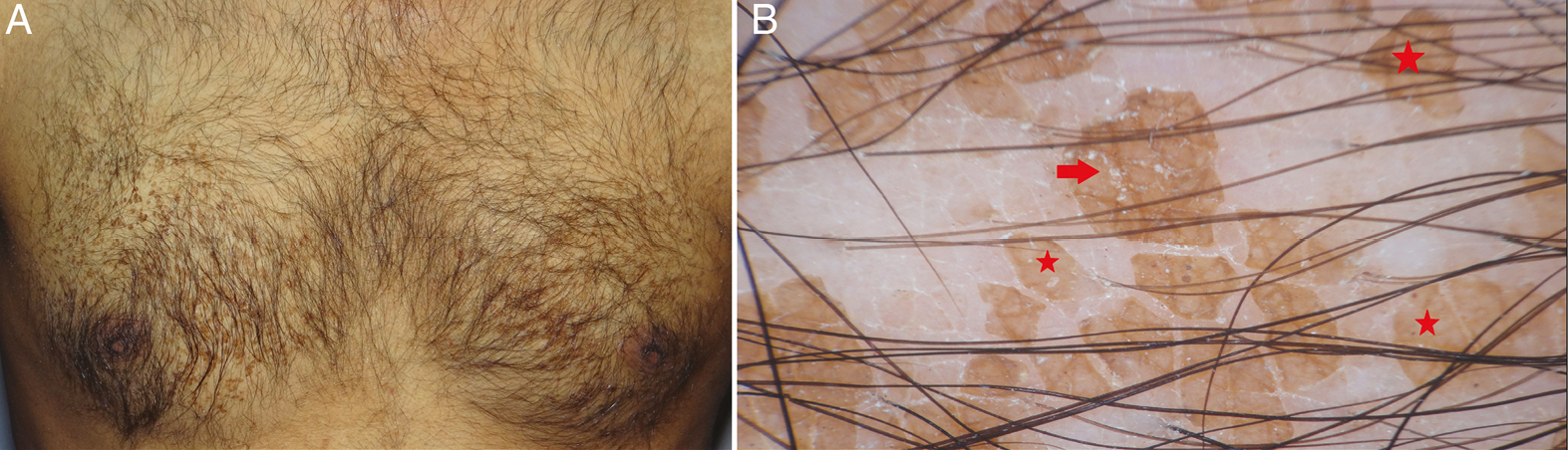 (A) Clinical image of terra firma-forme dermatosis showing hyperkeratotic, dirty-looking papules on the chest. (B) Dermoscopy shows polygonal yellowish-brown globules (red stars) with regular margins. Scales are seen on the surface and edge of globules (red arrow). Global view gives an impression of a “mosaic” pattern (Illuco 1100 IDS, Polarized, 10x)