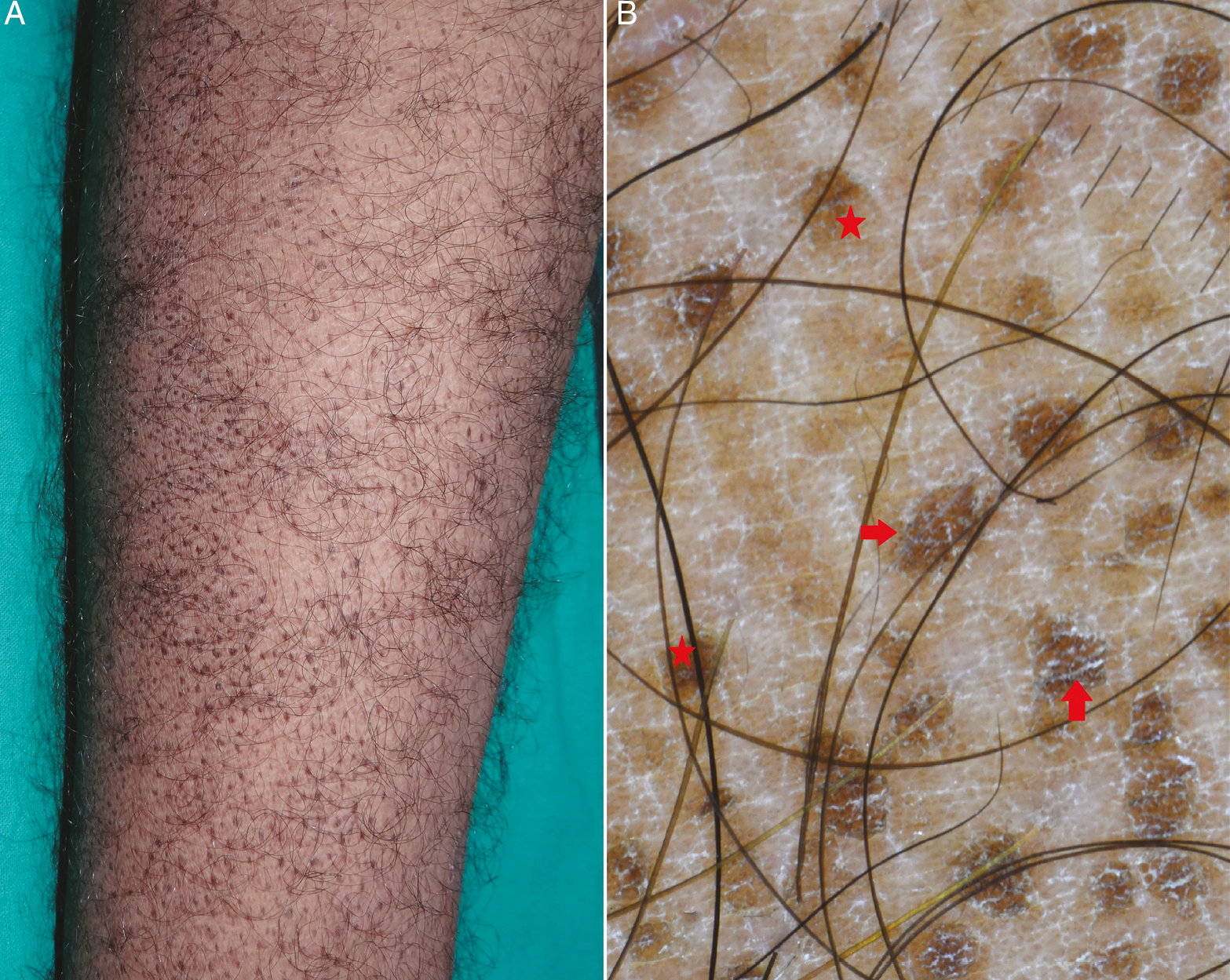 (A) Clinical image of terra firma-forme dermatosis showing hyperkeratotic, dirty-looking papules on the lower limb. (B) Dermoscopy shows a “mosaic” pattern in global view. Polygonal yellowish-brown globules (red stars) with regular margins are well appreciated. Scales are seen on the surface and edge of globules (red arrow) (Illuco 1100 IDS, Polarized, 10x)