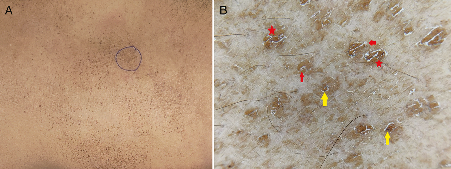 (A) Clinical image of terra firma-forme dermatosis showing hyperkeratotic, dirty-looking papules on the trunk. Area is marked for alcohol swab test.(B) Dermoscopy shows a “mosaic” pattern in global view. Polygonal yellowish-brown globules (red stars) with regular margins are well appreciated. Scales are seen on the surface and edge of globules (red arrow). Note the black dots (yellow arrows) studded on the pigment globules (Illuco 1100 IDS, Polarized, 10x)