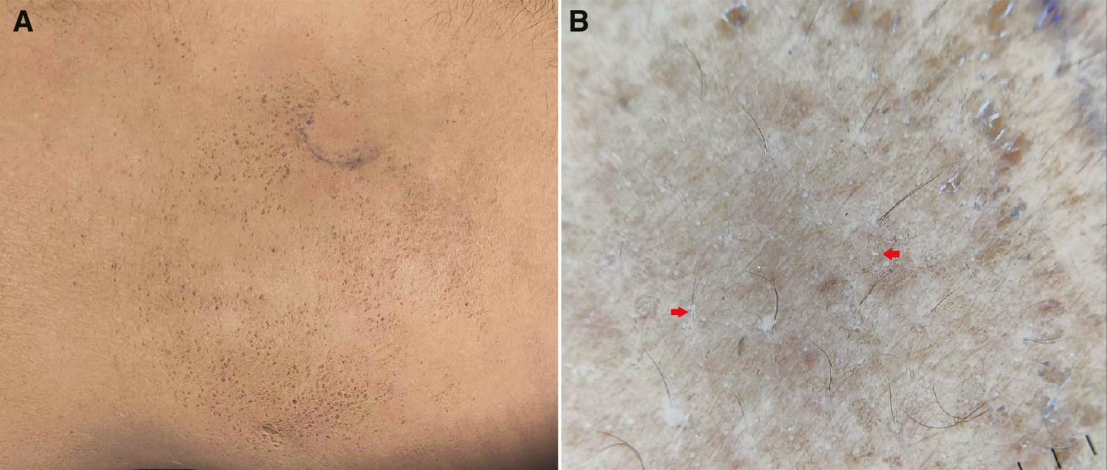 (A) Clinical image of terra firma-forme dermatosis showing disappearance of papules on alcohol swab test. (B) Dermoscopy shows the absence of yellowish-brown globules. A few scales are noted (red arrows) (Illuco 1100 IDS, Polarized, 10x)