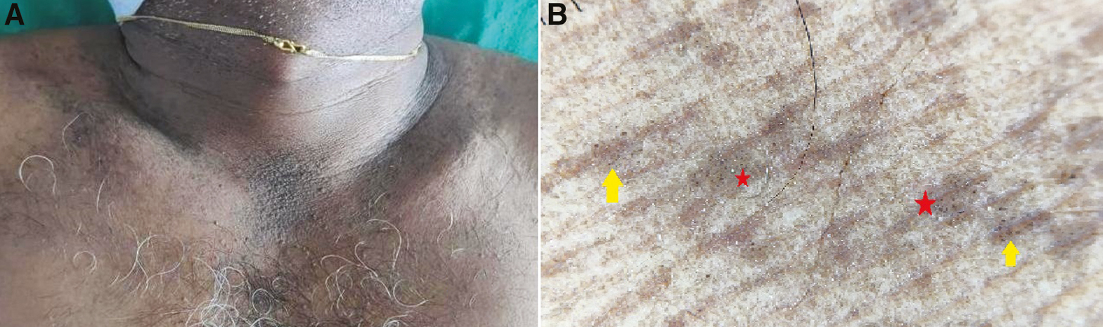 (A) Clinical image of terra firma-forme dermatosis showing hyperkeratotic, dirty-looking papules on anterior neck. (B) Dermoscopy shows regular arrangement of brown globules (red stars) studded with black dots (yellow arrows) (Illuco 1100 IDS, Polarized, 10x)