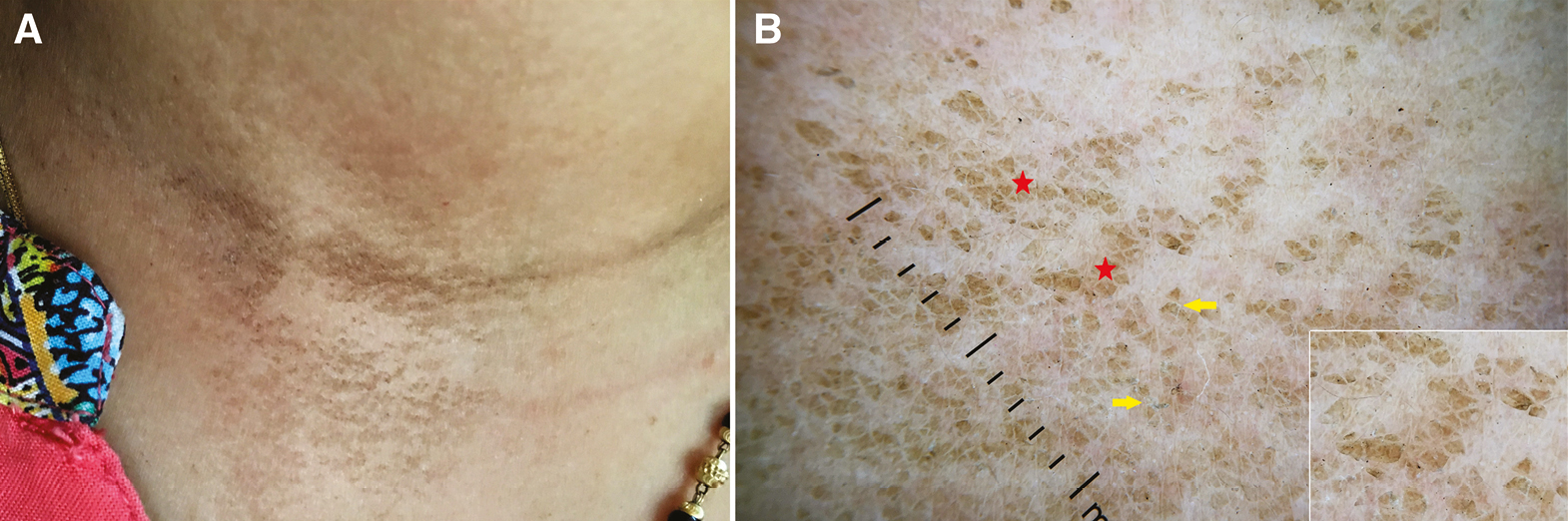 (A) Clinical image of dermatitis neglecta showing hyperkeratotic and hyperpigmented, dirty-looking papules on anterior neck. (B) Dermoscopy shows irregular brown globules (red stars) with everted edges (yellow arrows), giving a “cornflake-like” appearance. Inset depicts close-up view (Illuco 1100 IDS, Polarized, 10x)