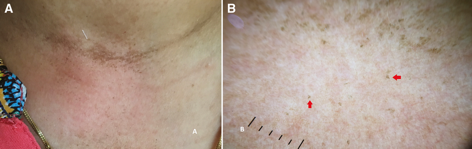 (A) Clinical image of dermatitis neglecta showing disappearance of papules on soap water swab test. (B) Dermoscopy shows the absence of brown globules. A few scales (red arrows) are noted (Illuco 1100 IDS, Polarized, 10x)