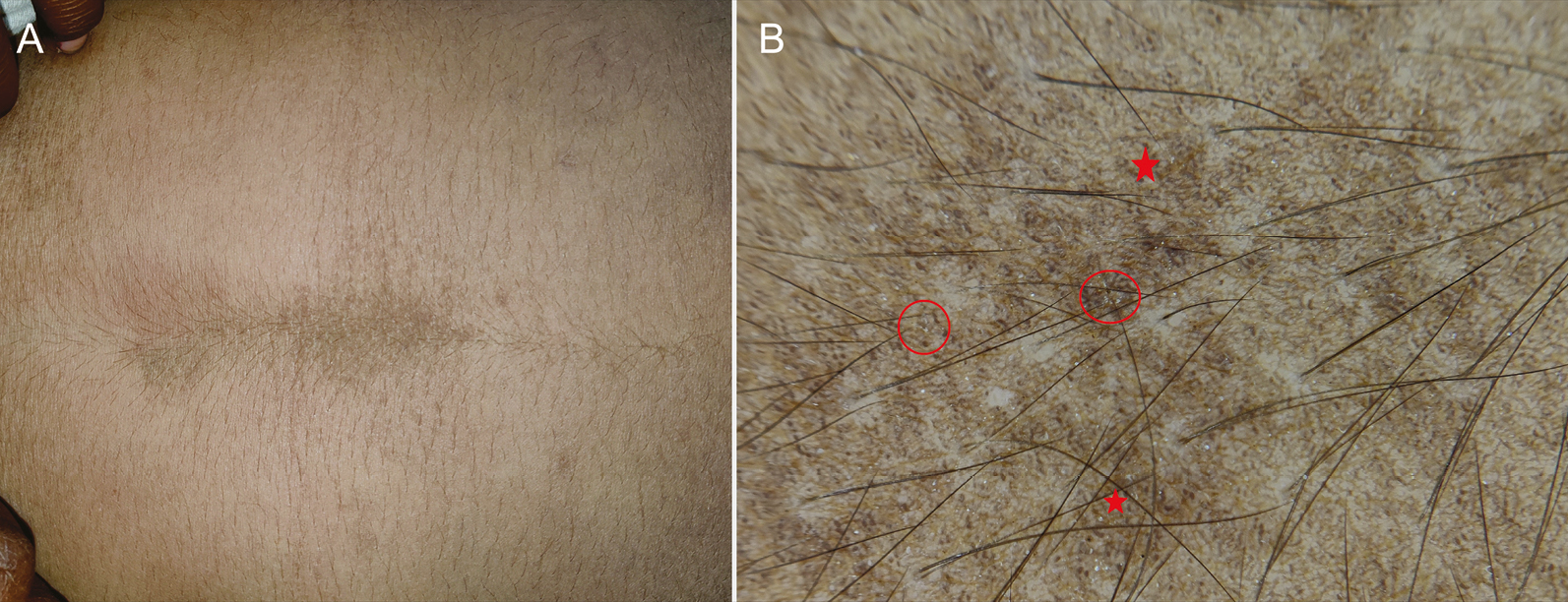 (A) Clinical image of dermatitis neglecta showing hyperkeratotic and hyperpigmented, dirty-looking papules on the abdomen. (B) Dermoscopy shows an irregular arrangement of blackish-brown globules and dots (red stars) and scales (red circles) (Illuco 1100 IDS, Polarized, 10x)