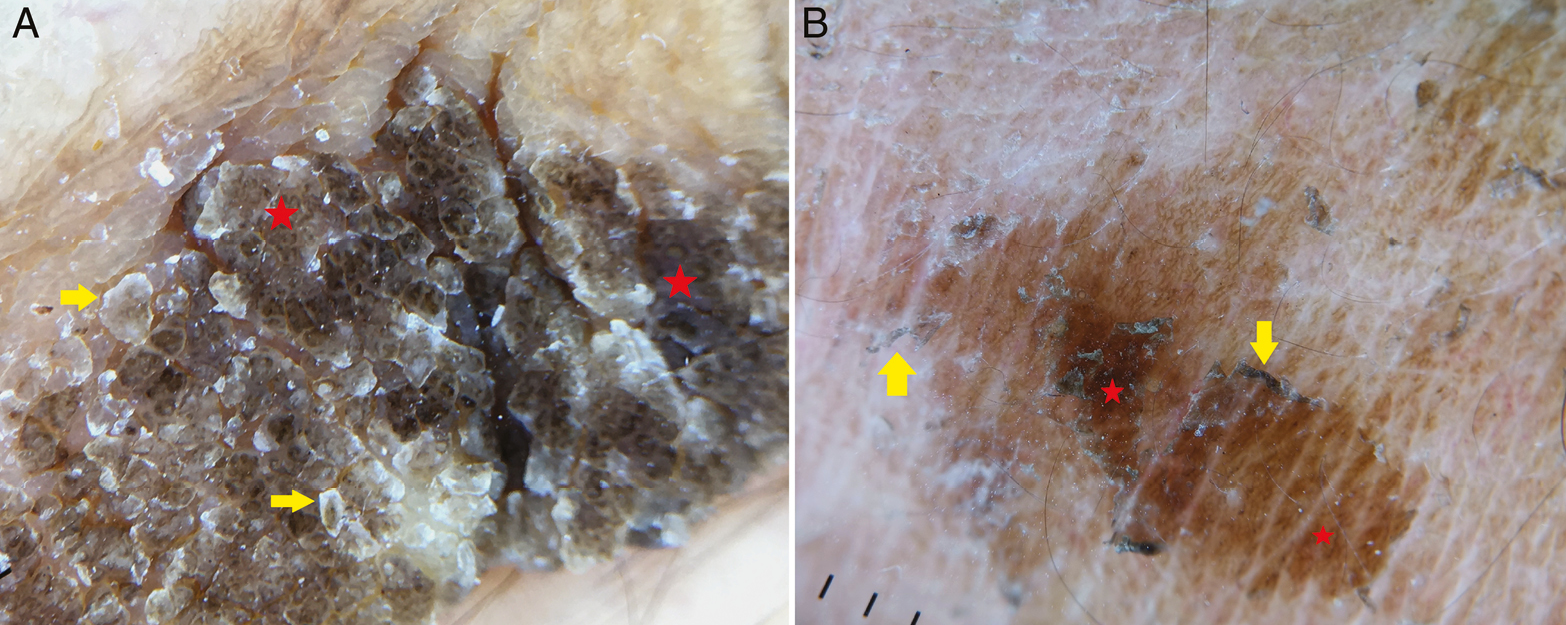 Dermoscopic image of dermatitis neglecta (A and B) shows irregular brown globules (red stars) with everted edges (yellow arrows), giving a “cornflake-like” appearance (Illuco 1100 IDS, Polarized, 10x)